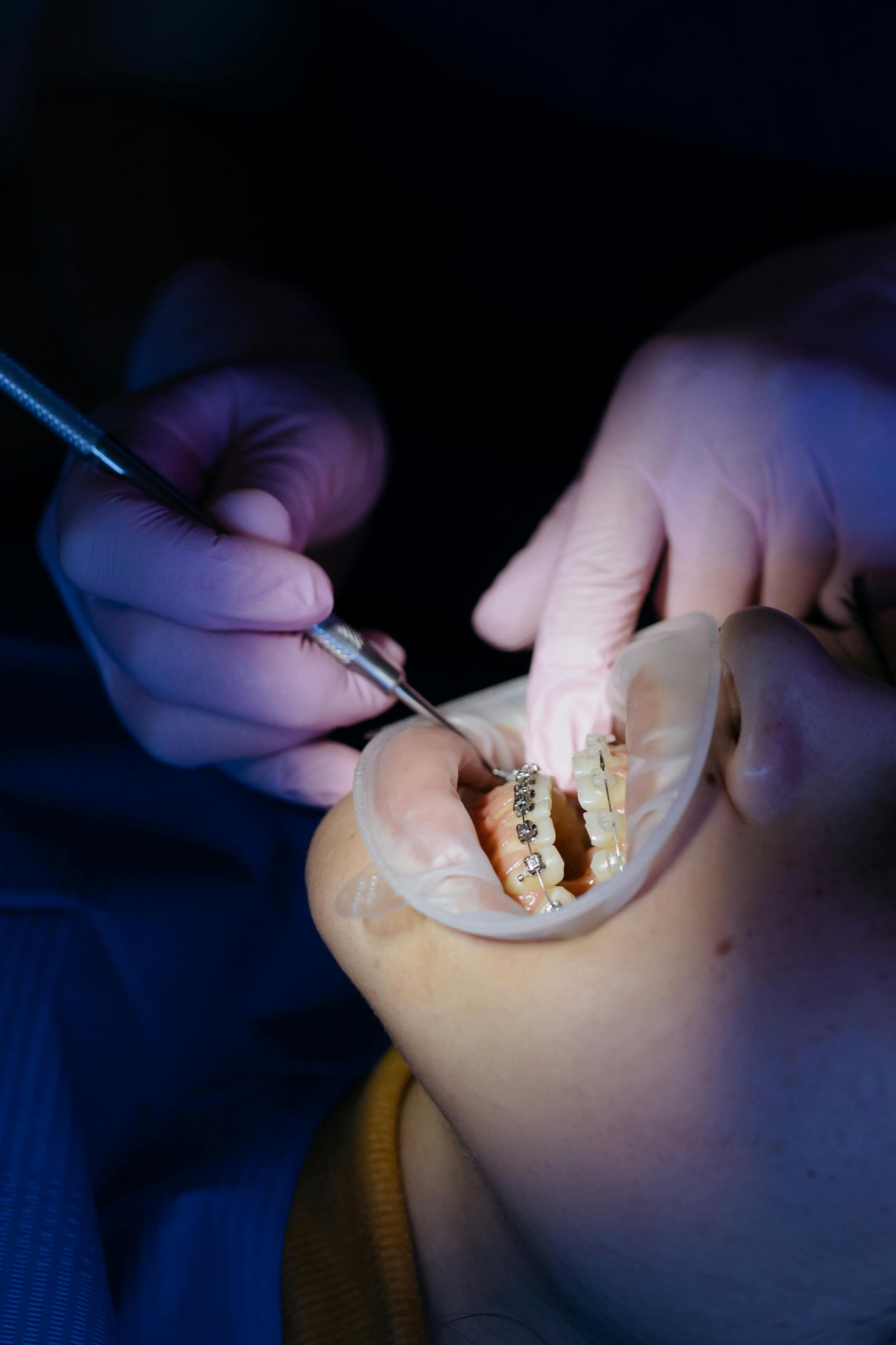 Aparat Dentar